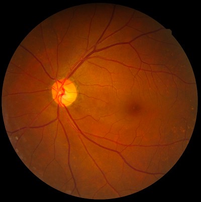 緑内障の眼底写真。視神経乳頭の陥凹拡大と神経線維の欠損を認める。