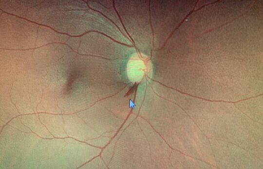 緑内障の眼底写真。下方に乳頭出血を認める。