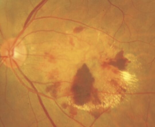 図5.眼底写真でみる網膜の出血