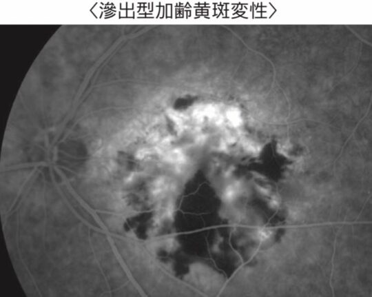 図10.滲出型加齢黄斑変性の眼底造影検査（フルオレセイン造影検査）